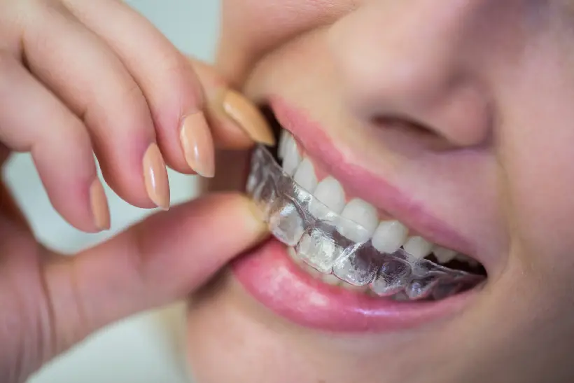 Mulher colocando alinhador invisível transparente nos dentes