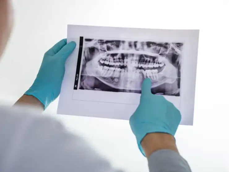Radiografia odontológica mostrando preservação óssea com implante dentário