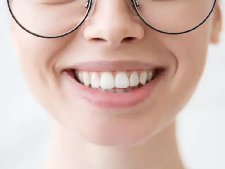 Sorriso natural após implante dentário na Clínica Dra. Denise Trombini