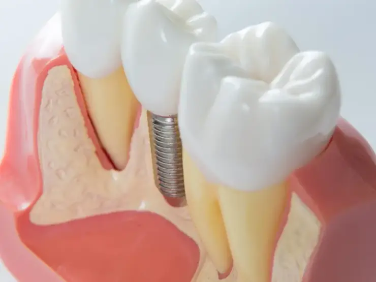 Implante dentário unitário para reposição de um único dente