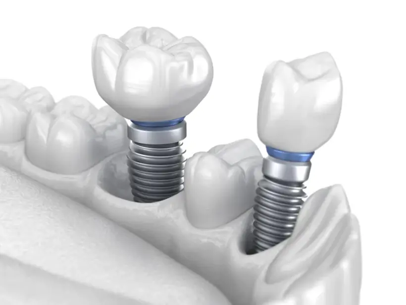 Implantes dentários de titânio instalados no osso com coroas protéticas