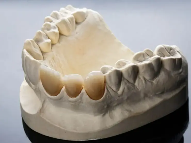Reabilitação oral completa com implantes dentários