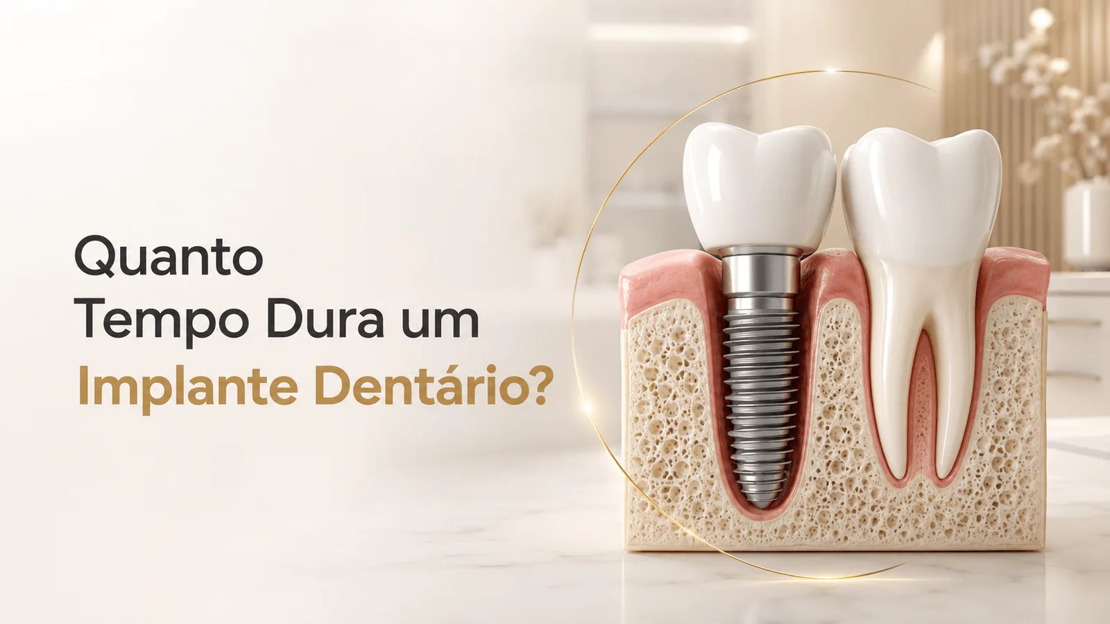 Quanto tempo dura um implante dentário? Veja Como Aumentar Sua Vida Útil