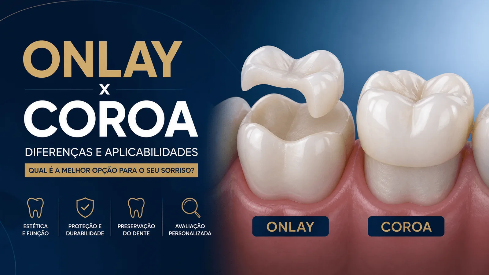 Onlay ou Coroa Dentária em Osasco: Entenda as Diferenças e Descubra o Melhor Tratamento