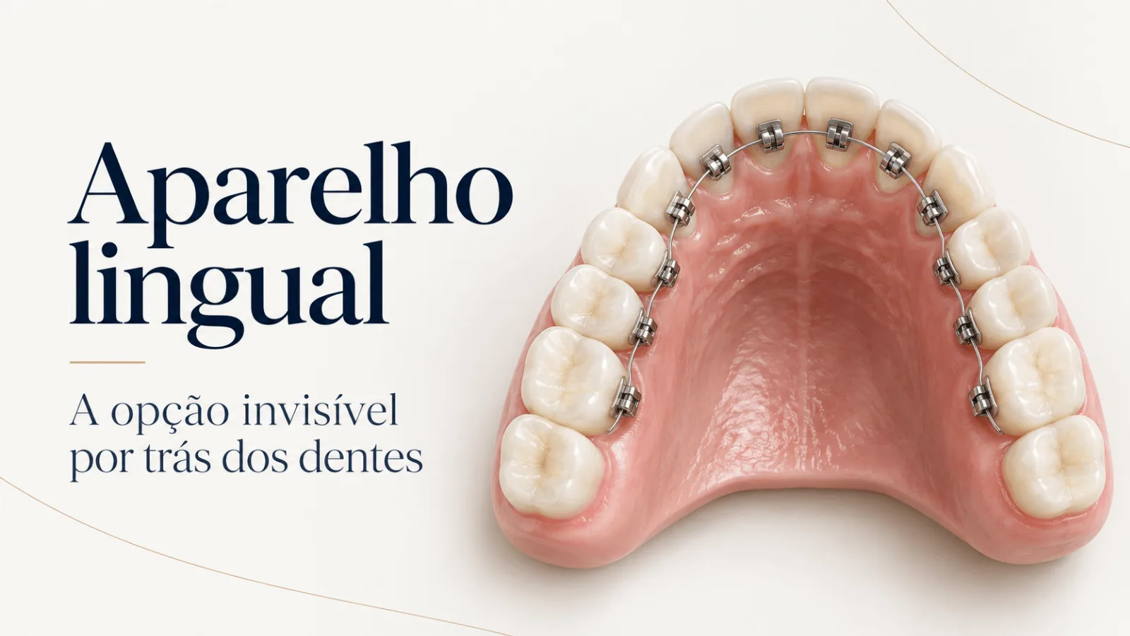 Ilustração da arcada dentária superior com aparelho lingual fixado na parte interna dos dentes, acompanhada do título “Aparelho lingual: a opção invisível por trás dos dentes”