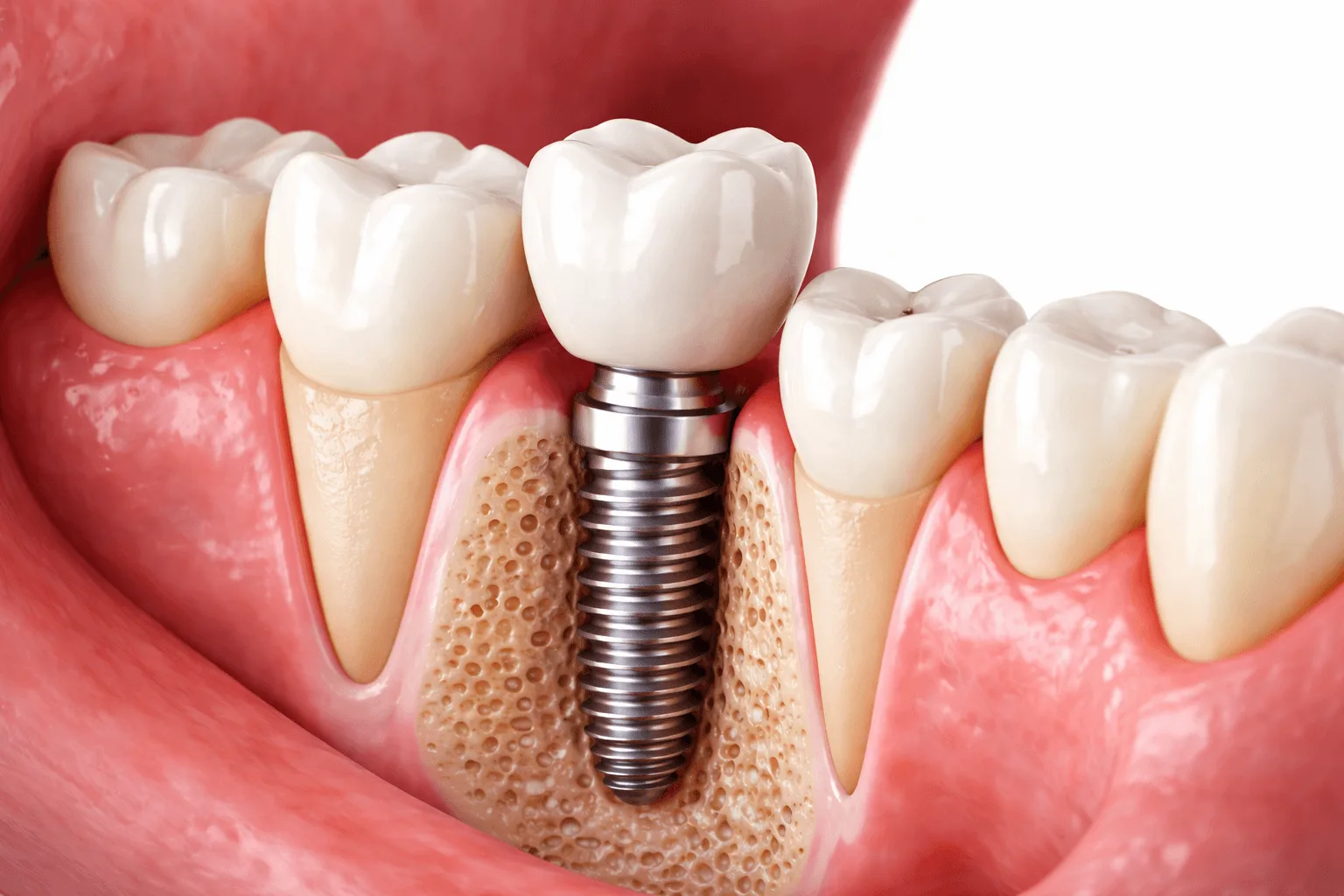 Procedimento de implante dentário e como funciona a substituição de dentes perdidos